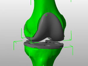 knee joint prosthesis with guides sample of individual prosthetics 3D Model