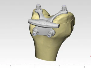knee joint prosthesis with guides sample of individual prosthetics 3D Model