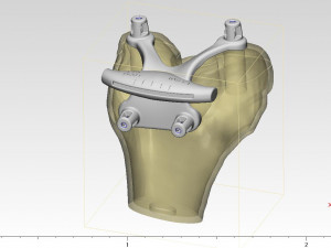 knee joint prosthesis with guides sample of individual prosthetics Modelo 3D