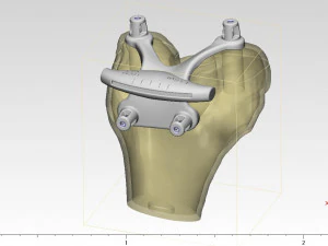 knee joint prosthesis with guides sample of individual prosthetics 3D Model