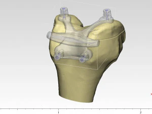 knee joint prosthesis with guides sample of individual prosthetics 3D Model