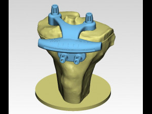 knee joint prosthesis with guides sample of individual prosthetics Modelo 3D