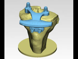 knee joint prosthesis with guides sample of individual prosthetics 3D Model