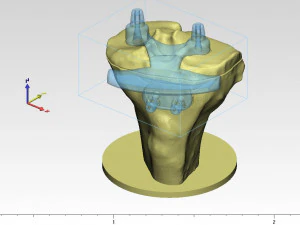knee joint prosthesis with guides sample of individual prosthetics 3D Model