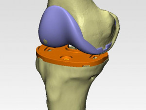 knee joint prosthesis with guides sample of individual prosthetics 3D Model