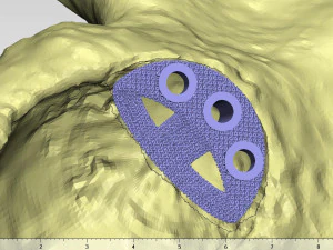 individual acetabulum augment 3D Print Model