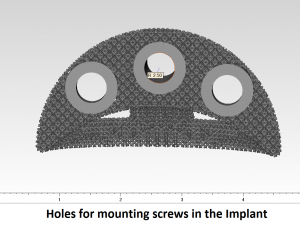 individual acetabulum augment Modèles 3D en vedette