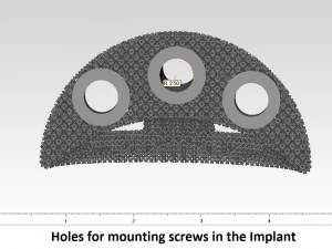 individual acetabulum augment 3D Print Model