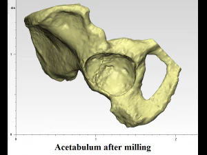 individual acetabulum augment 3D Print Model