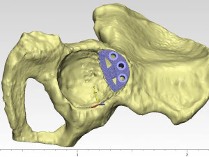individual acetabulum augment 3D Print Model