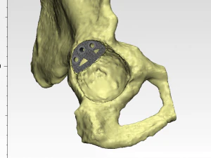 individual acetabulum augment 3D Print Model