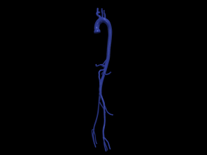 Aortofemoral Model 3D