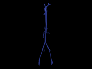 Aortofemoral Model 3D