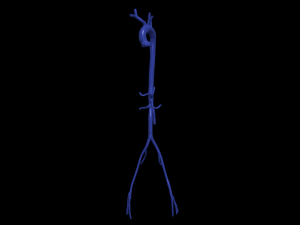 Aortofemoral Model 3D