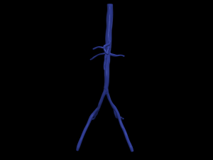 Aortofemoral 3D 模型