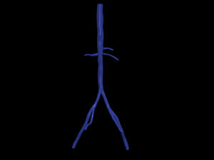 Aortofemoral 3D मॉडल
