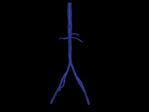 Aortofemoral 3D Model