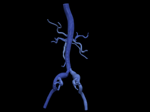 Aortofemoral 3D 模型