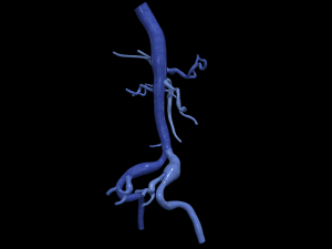 Aortofemoral 3Dモデル