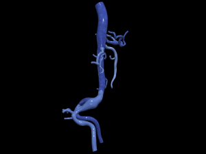Aortofemoral 3Dモデル
