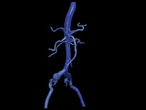 Aortofemoral 3Dモデル