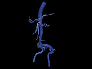 Aortofemoral 3Dモデル