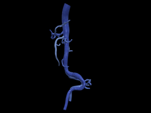 Aortofemoral 3Dモデル