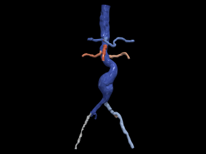 Aortofemoral Modèle 3D