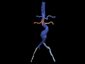 Aortofemoral 3D Model