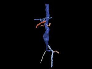 Aortofemoral 3D Model