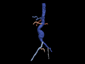 Aortofemoral Modèle 3D