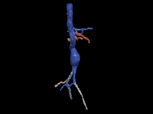 Aortofemoral Modèle 3D