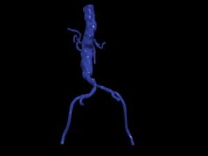 Aortofemoral 3D 模型