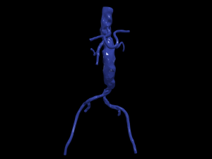 Aortofemoral 3Dモデル