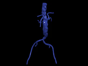 Aortofemoral 3D Model