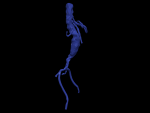 Aortofemoral 3Dモデル
