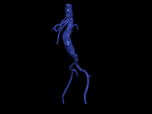 Aortofemoral 3Dモデル