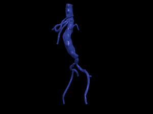 Aortofemoral 3D Model