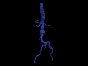 Aortofemoral Modelo 3D