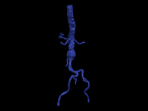 Aortofemoral 3D Model