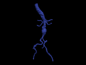 Aortofemoral Modelo 3D