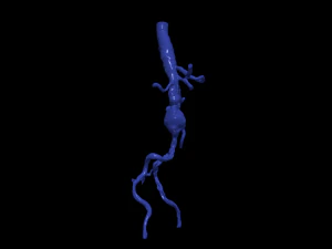Aortofemoral 3D Model