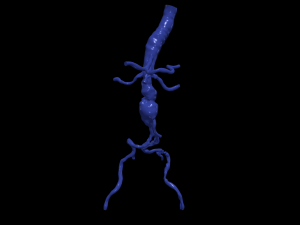 Aortofemoral Modelo 3D