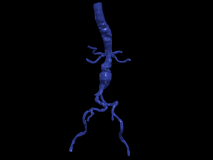 Aortofemoral Modelo 3D