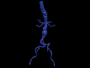 Aortofemoral 3D Model