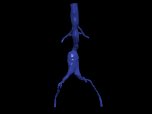 Aortofemoral 3D Model