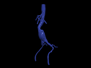 Aortofemoral Model 3D