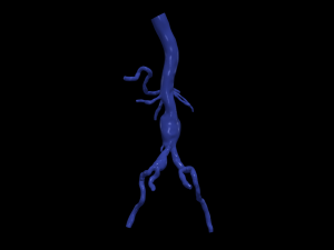 Aortofemoral 3D 模型