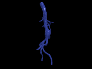 Aortofemoral Modelo 3D
