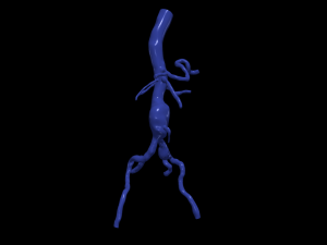 Aortofemoral Modelo 3D